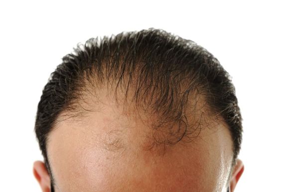 hair loss treatments for men in Nottingham